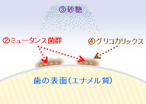 2．虫歯（う蝕）の発生メカニズム - 江南市の歯医者 緑が丘歯科医院 歯 