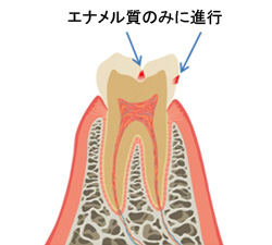 むし歯治療の詳細