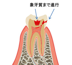 むし歯治療の詳細