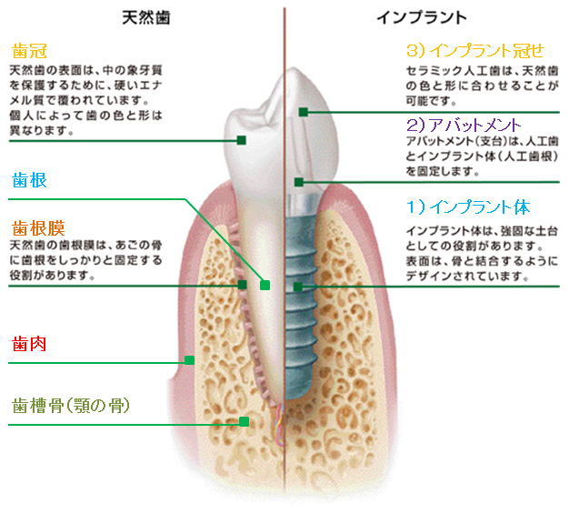 3．インプラントとは、どのようなものなのか？ - 江南市の歯医者