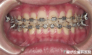 3．矯正装置の種類 - 江南市の歯医者 緑が丘歯科医院 歯周病・矯正 