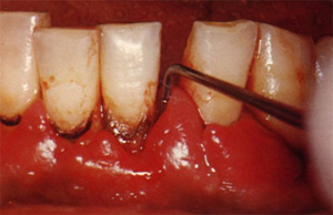 歯周病治療の詳細