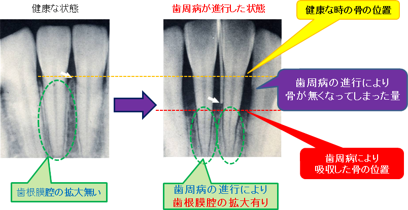歯周病治療の詳細